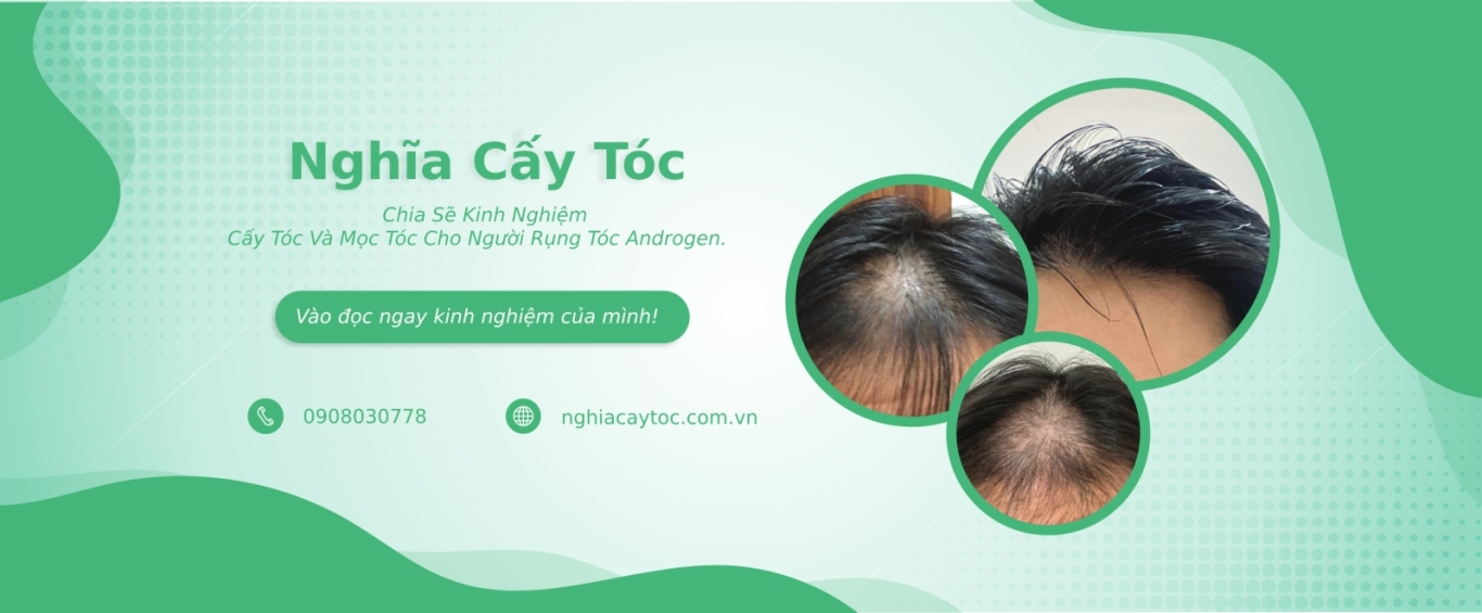 Vào đọc ngay để tìm hiểu cách điều trị rụng tóc từ kinh nghiệm của Nghĩa