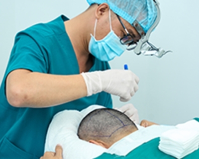 Cấy Tóc Mất Bao Lâu? Thời Gian Phục Hồi Sau Khi Cấy Tóc
