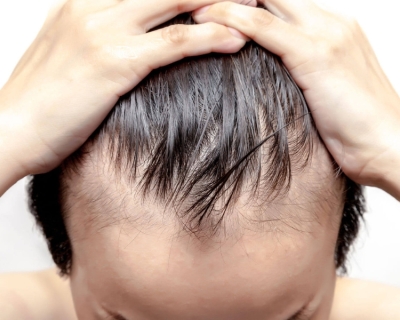 Cách Chữa Hói Đầu Ở Nam Giới Hiệu Quả