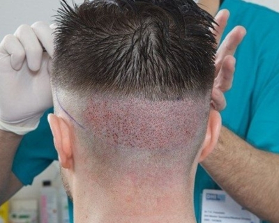Cấy Tóc Là Gì ? Phương Pháp & Chi Phí Thực Hiện
