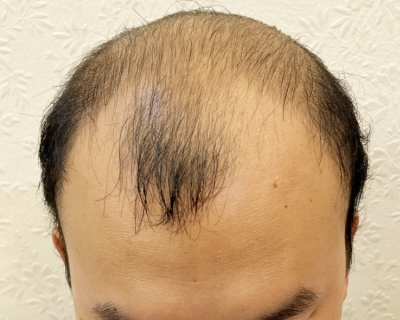 Cấy tóc sinh học là gì? Ưu và nhược điểm