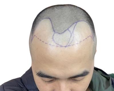 Cấy tóc vùng trán bao nhiêu tiền?