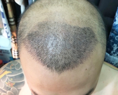 Cấy tóc xong có bị rụng lại không? Tại sao?