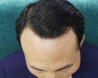 Hói Đầu Có Chữa Được Không? Cách Điều Trị