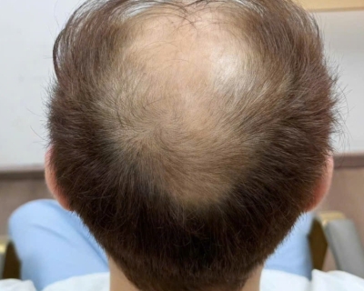 Mất chân tóc có mọc lại không? [GIẢI ĐÁP]