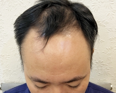 Nam Giới Có Nên Dùng Xịt Bưởi Khi Rụng Tóc Không?