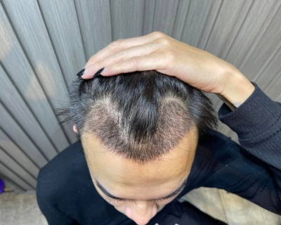 Nên cấy tóc hay hạ đường chân tóc?