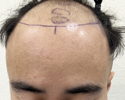 Nên cấy tóc ở đâu uy tín, an toàn, hiệu quả?
