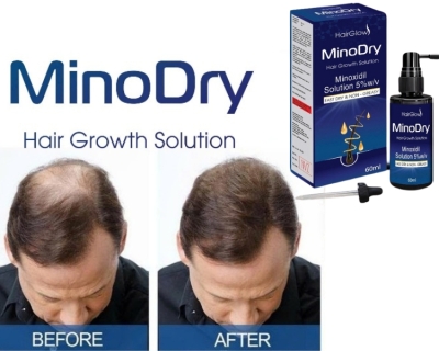 Review Minoxidil Mọc Tóc Sau 75 Ngày Của 1 Khách Hàng