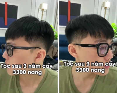 Review Sau 3 Năm Cấy Tóc Của Nghĩa Cấy Tóc