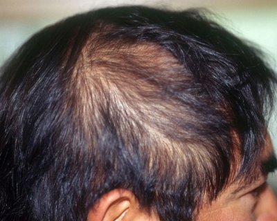 Rụng Tóc Di Truyền Là Gì? Cách Chữa Trị