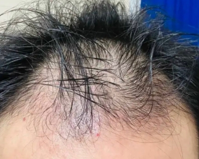 Rụng Tóc Do Di Truyền Xét Nghiệm Máu Có Ra Không?