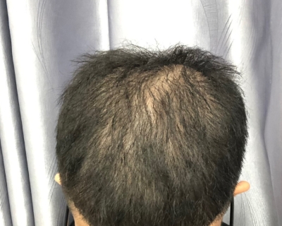 Rụng Tóc Hói Đầu Bao Lâu Thì Mất Nang?