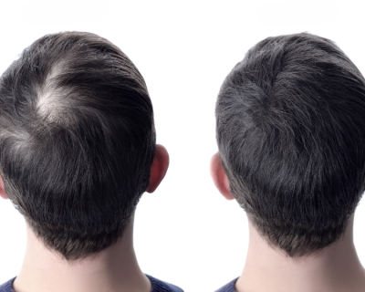 Rụng Tóc Hói Đầu Có Nhất Thiết Phải Đi Cấy Hay Không?