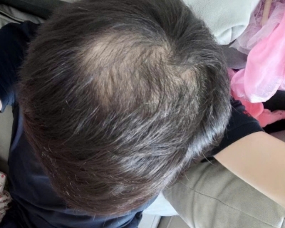 Rụng tóc nhiều ở nam tuổi dậy thì