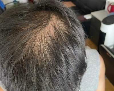 Rụng tóc thiếu chất gì?
