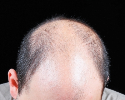 Rụng tóc toàn thể là gì? Nguyên nhân gây ra
