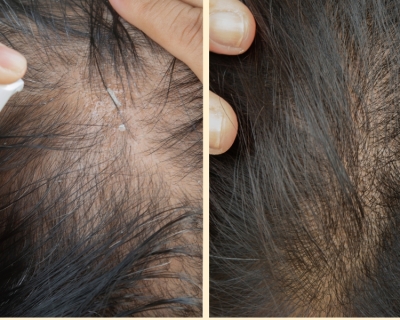 Tại Sao Dùng Minoxidil Mọc Tóc Lại Không Có Hiệu Quả?