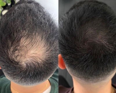 Thời gian hồi phục sau cấy tóc mất bao lâu?