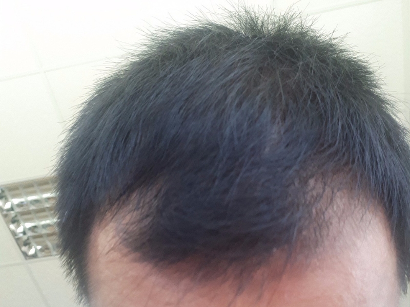 chuyen tu van giai phap dieu tri rung toc uy tin chat luong
