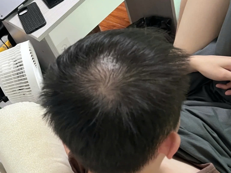 nguyen nhan rung toc o nam gioi