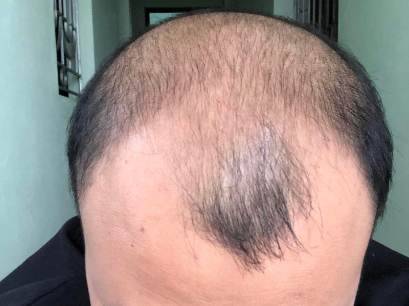 nguyen nhan gay rung toc