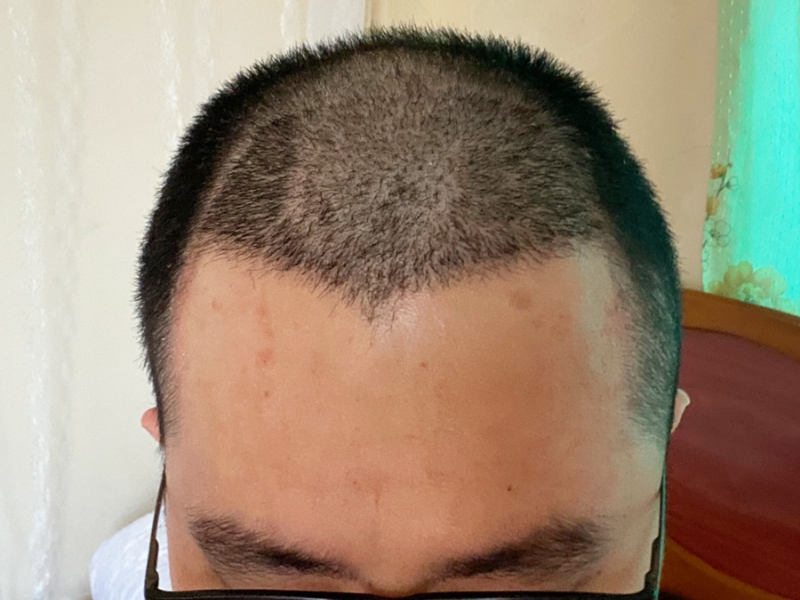 cam giac dau xuat hien trong giai doan nao khi cay toc