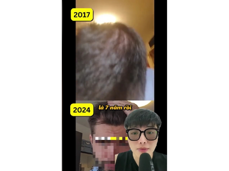 he qua khi dung minoxidil qua som de moc toc