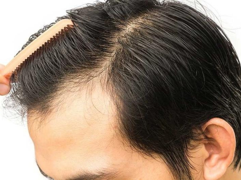 8 thoi quen xau lam tinh trang hoi dau them nghiem trong