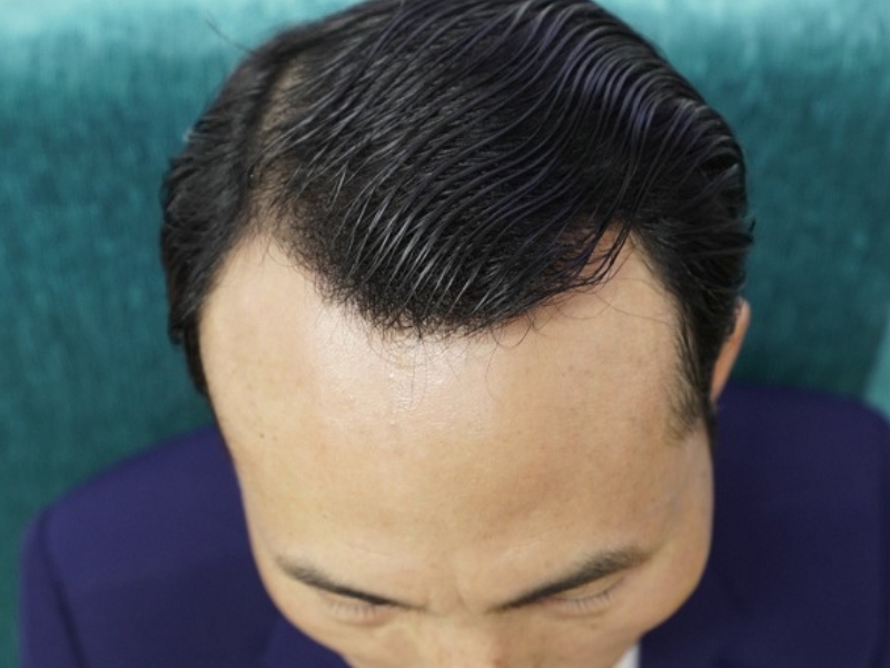 Tu van tri hoi nhiet tinh tan tam Nghia Cay Toc