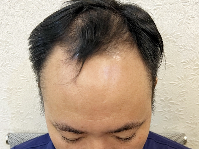 nguyen nhan gay rung toc o nam gioi