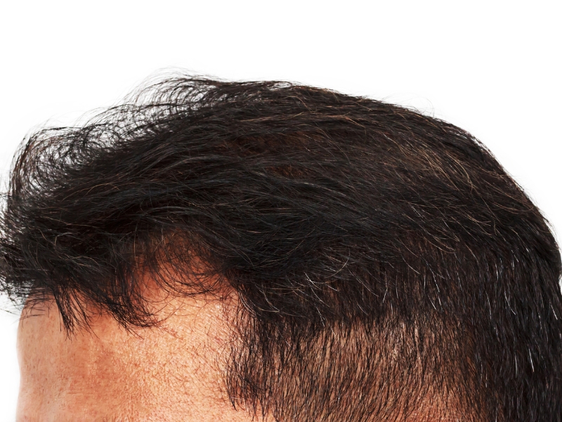 nam gioi bi rung toc di truyen nen dung xit buoi hay minoxidil