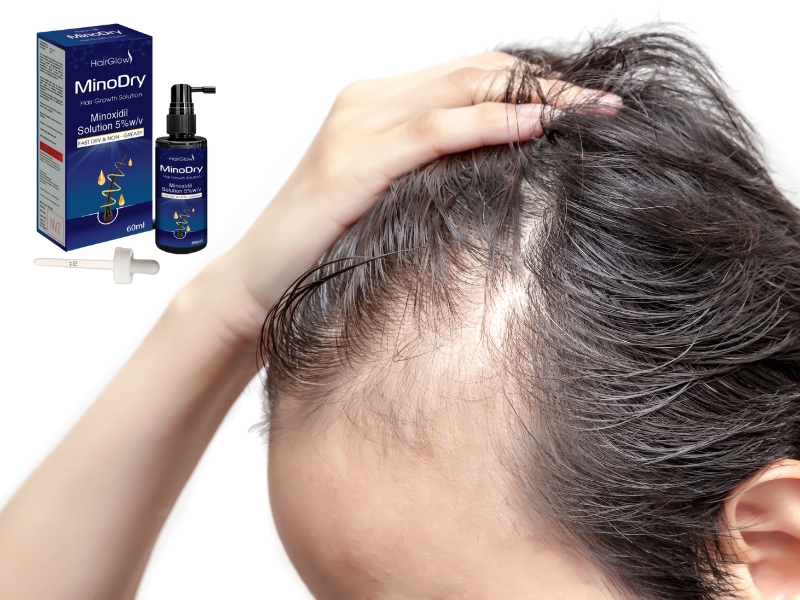 su khac biet giua minoxidil va cac loai xit moc toc khac