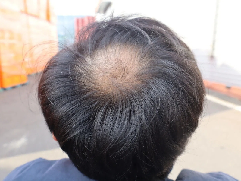 nghia cay toc cung cap giai phap cay toc an toan hieu qua