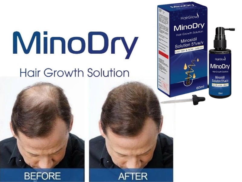 danh gia hieu qua cua minoxidil sau 75 ngay su dung