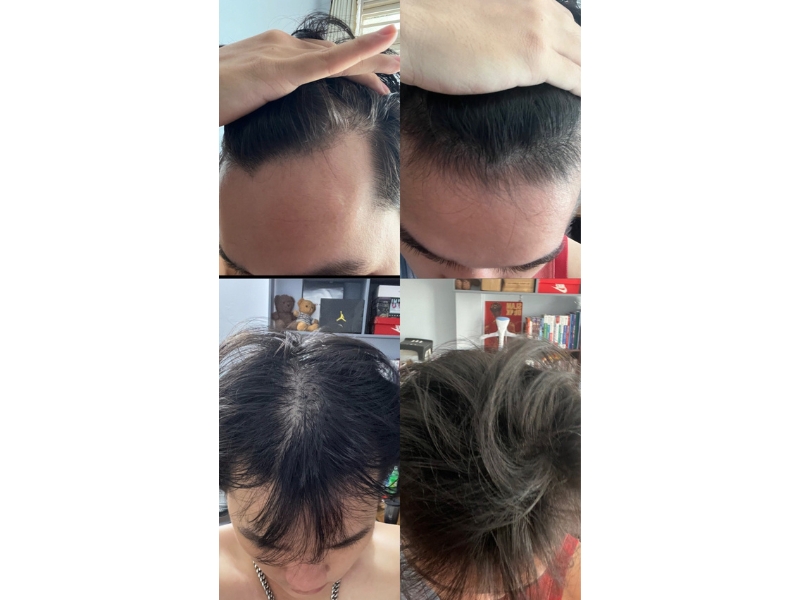 danh gia hieu qua cua minoxidil sau 75 ngay su dung tu mot khach hang
