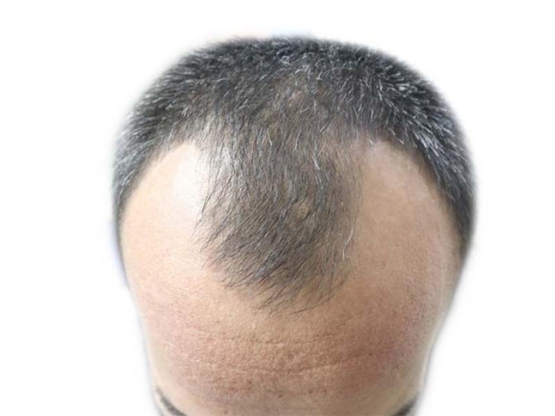 Nguyen nhan dan den rung toc androgen