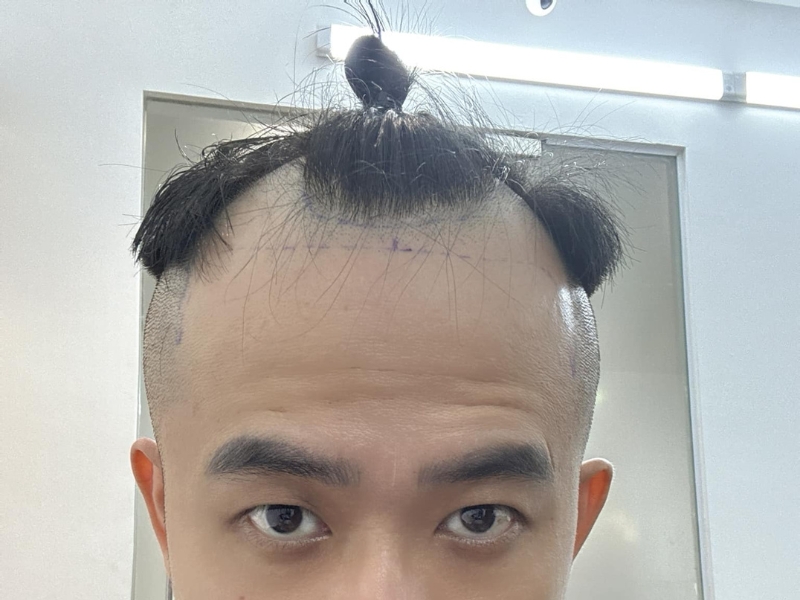 qua trinh rung toc o nam gioi dien ra nhu the nao
