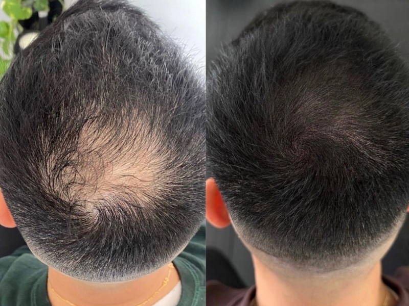 thoi gian phuc hoi sau cay toc mat bao lau